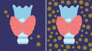 تفاوت کم کاری و پرکاری تیروئید چیست؟ علت، علائم و درمان-min