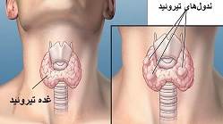 ندول تیروئید درمان گره تیروئید کم کار و پرکار با دارو و جراحی