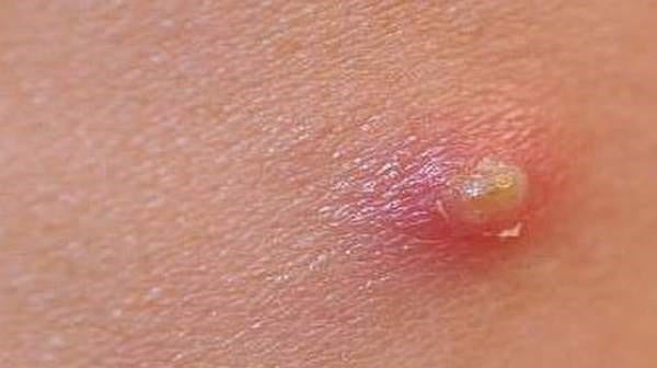 چرا واکسن HPV مهم است؟