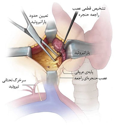 آنچه در طی جراحی غده پاراتیروئید اتفاق خواهد افتاد