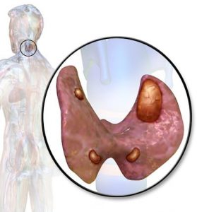 انواع جراحی غده پاراتیروئید برای درمان اختلالات آن